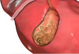 重磅!信达FGFR抑制剂佩米替尼片在国内获批上市!